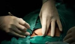 剖腹产视频,直观呈现母婴安全守护